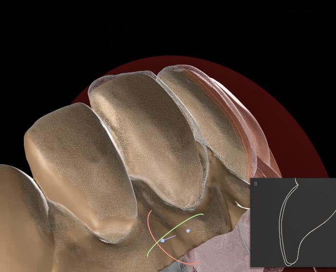 Darstellung der Präparation für Veneers.