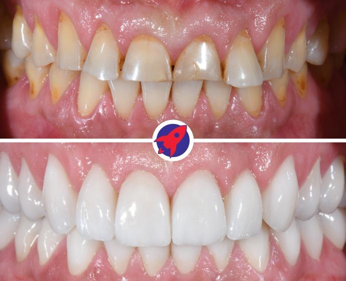 Vorher-nachher Bild einer Zahnsanierung bei der die abgenutzten Zähne mit Invisalign Alignern verschoben, und anschließend mit Zahnkronen versorgt wurden.