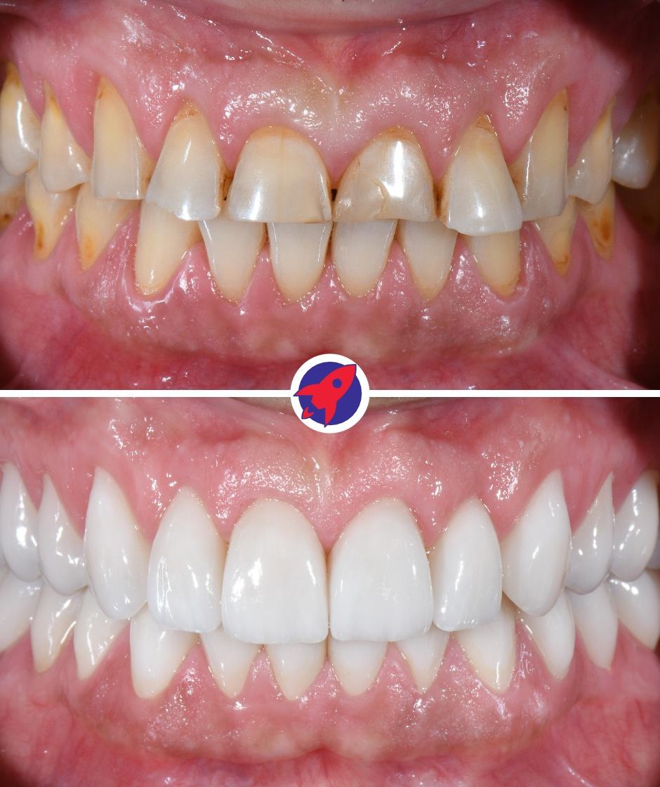 Vorher-nachher Bild einer Zahnsanierung bei der die abgenutzten Zähne mit Invisalign Alignern verschoben, und anschließend mit Zahnkronen versorgt wurden.