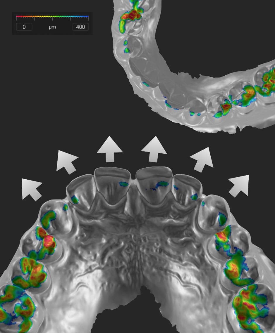 Hochauflösendes digitales 3D-Modell eines Gebisses mit sichtbarer Zahnabnutzung, farbcodiert zur Darstellung verschiedener Abnutzungsstufen, ideal zur Patientenaufklärung und Behandlungsplanung in der Zahnmedizin.