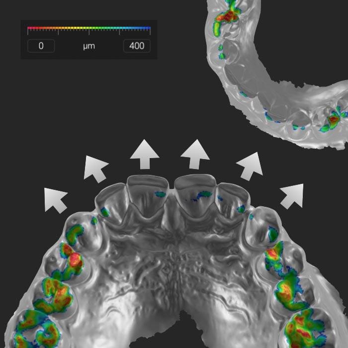Hochauflösendes digitales 3D-Modell eines Gebisses mit sichtbarer Zahnabnutzung, farbcodiert zur Darstellung verschiedener Abnutzungsstufen, ideal zur Patientenaufklärung und Behandlungsplanung in der Zahnmedizin.