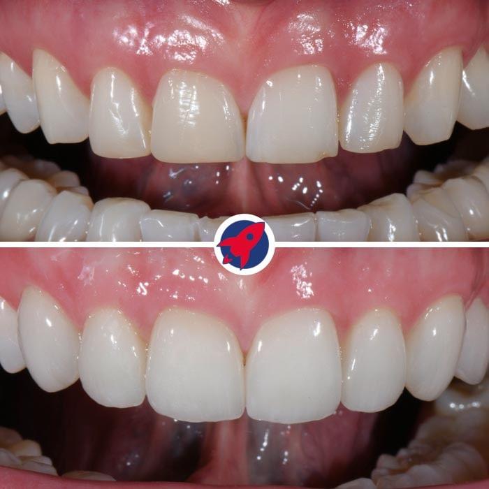 Transformation eines Lächelns durch sieben maßgeschneiderte Veneers, angebracht von Dr. Horváth, die eine harmonische Zahnform und Farbe für ein natürlich aussehendes Ergebnis erzielen.