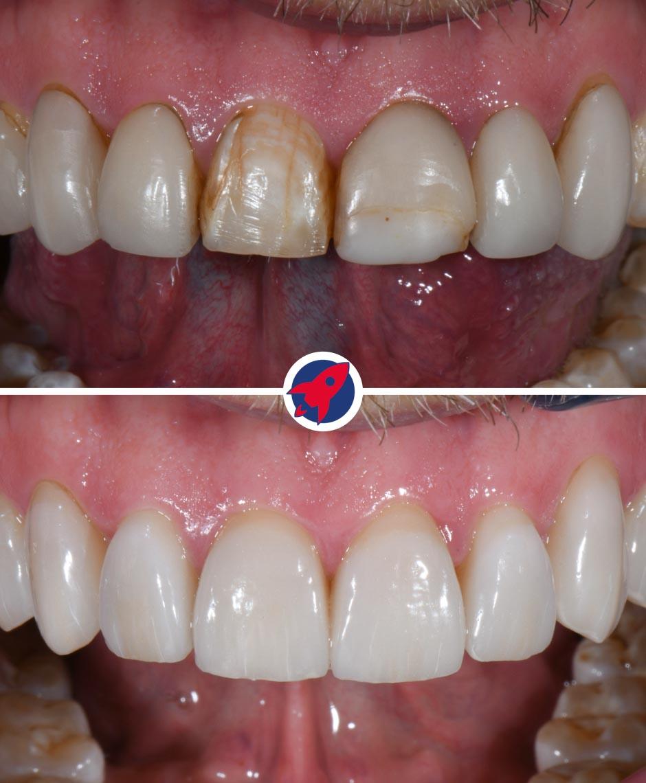 Verwandlung eines Lächelns mit dem Austausch alter Veneers durch neue, von Dr. Horváth individuell angefertigte Veneers, um die Zahnästhetik zu modernisieren und zu verjüngen.