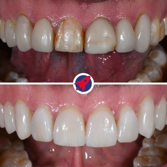 Verwandlung eines Lächelns mit dem Austausch alter Veneers durch neue, von Dr. Horváth individuell angefertigte Veneers, um die Zahnästhetik zu modernisieren und zu verjüngen.