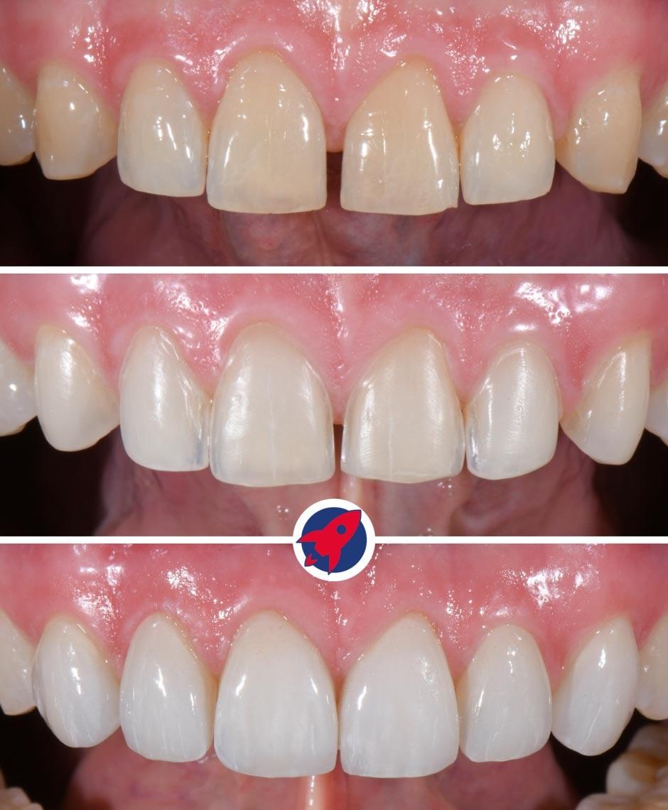 Vorher- und Nachher-Bilder, die den Prozess der Vorbereitung und Anbringung von sechs Veneers durch Dr. Horváth zeigen, ein Einblick in die präzise Handwerkskunst der ästhetischen Zahnmedizin.