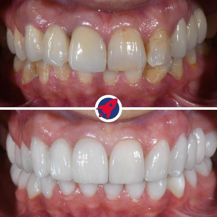 Eine weitere Vorher-Nachher-Aufnahme, die die geschickte Arbeit von Dr. Horváth hervorhebt, bei der Veneers und Invisalign eingesetzt wurden, um ein symmetrisches und ansprechendes Lächeln zu kreieren.