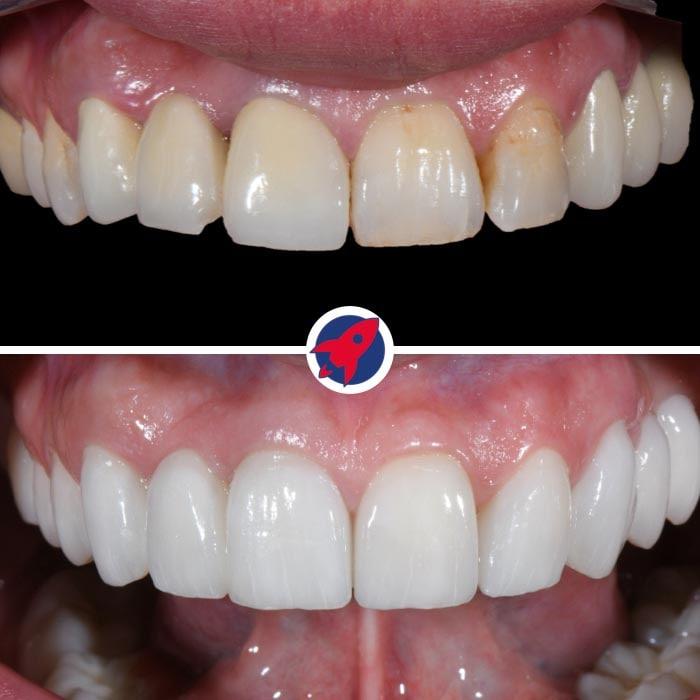Ästhetische Zahnsanierung mit einem beeindruckenden Vorher-Nachher-Vergleich, der die Anwendung von Veneers und Invisalign durch Dr. Horváth zeigt, um einheitlich lange und schöne Zähne zu erzielen.