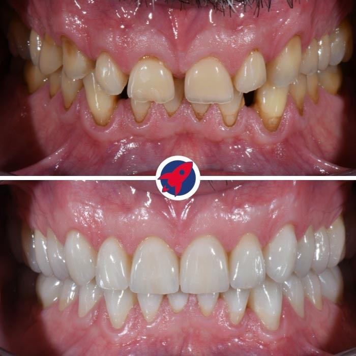 Transformation des Lächelns eines Patienten durch eine umfassende Behandlung mit Veneers, Zahnkronen und Zahnspange, die das Erscheinungsbild der Zähne verbessert und die Zahngesundheit wiederherstellt.