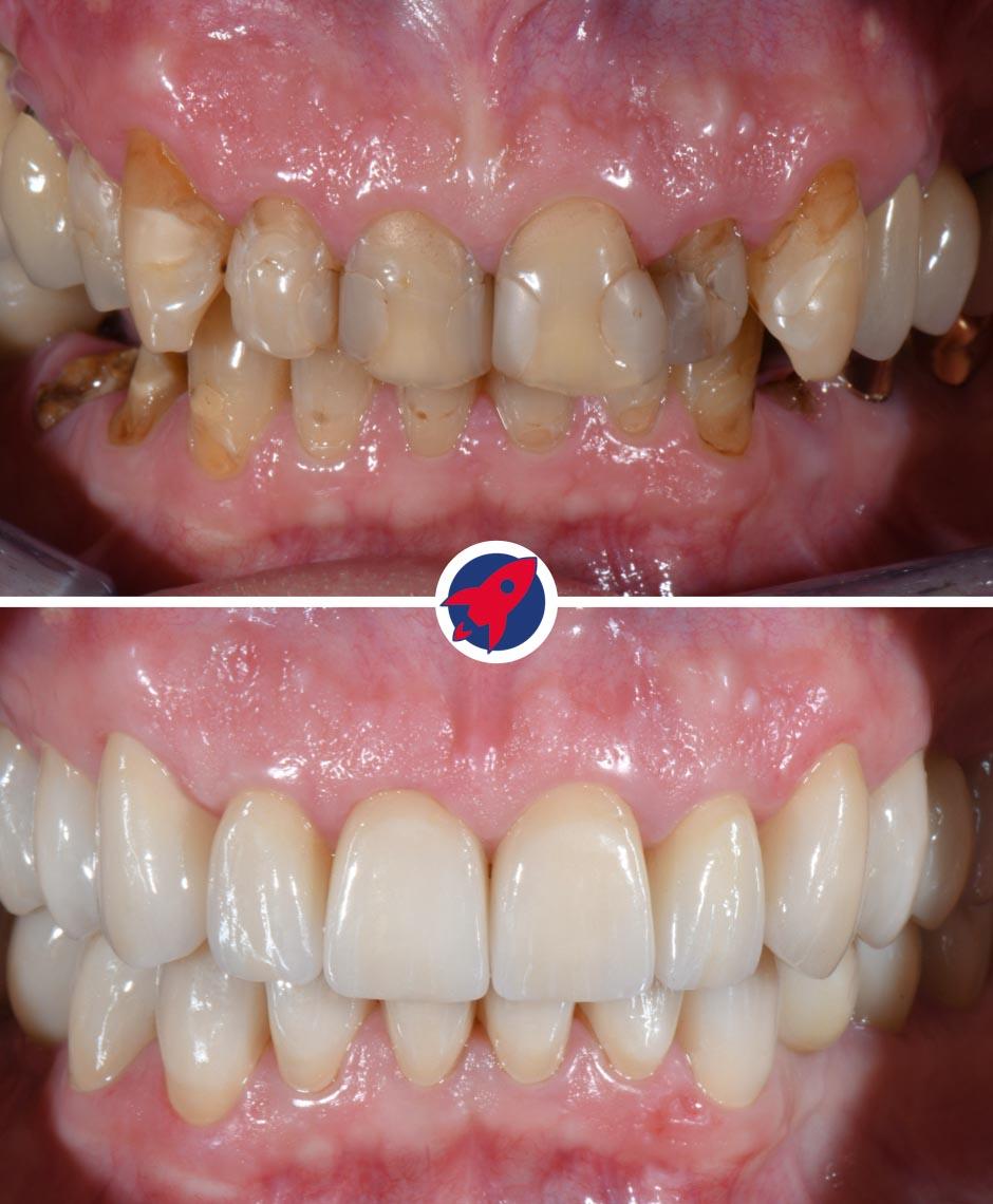 Vorher-Nachher-Bilder eines Patienten, der eine umfangreiche zahnmedizinische Sanierung einschließlich Zahnkronen, Invisalign, einer Zahnspange und Implantaten erfahren hat, umfassend restauriert für optimale Ästhetik und Funktion.