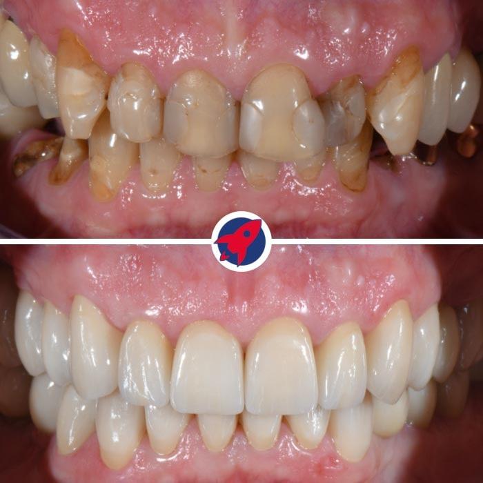 Vorher-Nachher-Bilder eines Patienten, der eine umfangreiche zahnmedizinische Sanierung einschließlich Zahnkronen, Invisalign, einer Zahnspange und Implantaten erfahren hat, umfassend restauriert für optimale Ästhetik und Funktion.