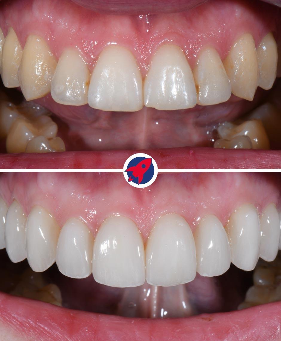Ästhetische Verbesserung des Oberkiefers mit zehn Veneers und Invisalign-Behandlung zur Schaffung einer harmonischen Zahnform und eines strahlenden Lächelns.