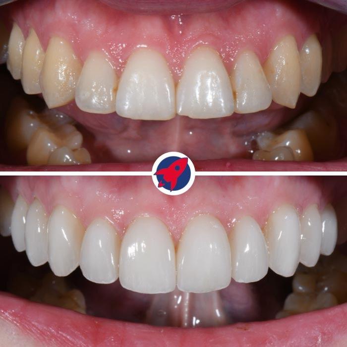 Vorher-Nachher-Bilder eines Patienten, bei dem zehn Veneers in Verbindung mit Invisalign für ein ästhetisches Lächeln mit schöner Zahnform angepasst wurden.
