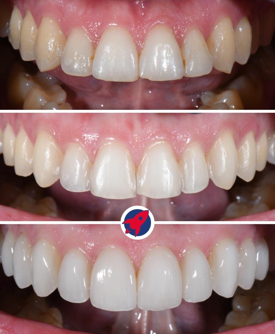 Darstellung der Vorbereitung für zehn Veneers im Oberkiefer in Kombination mit Invisalign für eine optimale Zahnform und Ästhetik.
