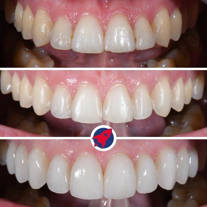 Darstellung der Vorbereitung für zehn Veneers im Oberkiefer in Kombination mit Invisalign für eine optimale Zahnform und Ästhetik.