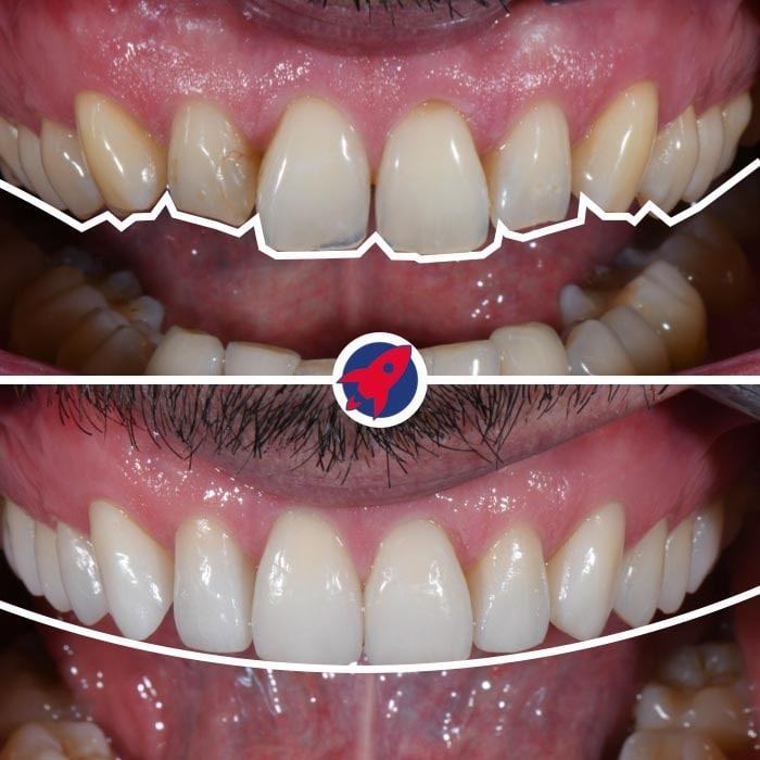Vorherige Ansicht eines Lächelns, das durch zwölf Veneers und Invisalign verbessert wurde, wodurch eine ästhetische Zahnform und ein verbessertes Lächeln erreicht wurden.