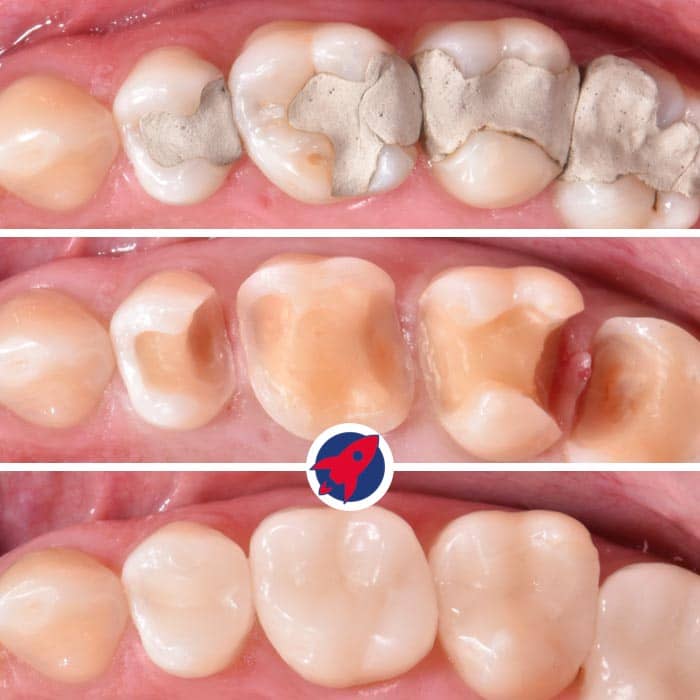 Vorher-nachher Bildvergleich einer zahnärztlichen Behandlung mit Inlays und Onlays, einschließlich der detaillierten Darstellung der Präparationsphasen – effiziente und ästhetische Lösungen für Zahnerhalt und -restauration.