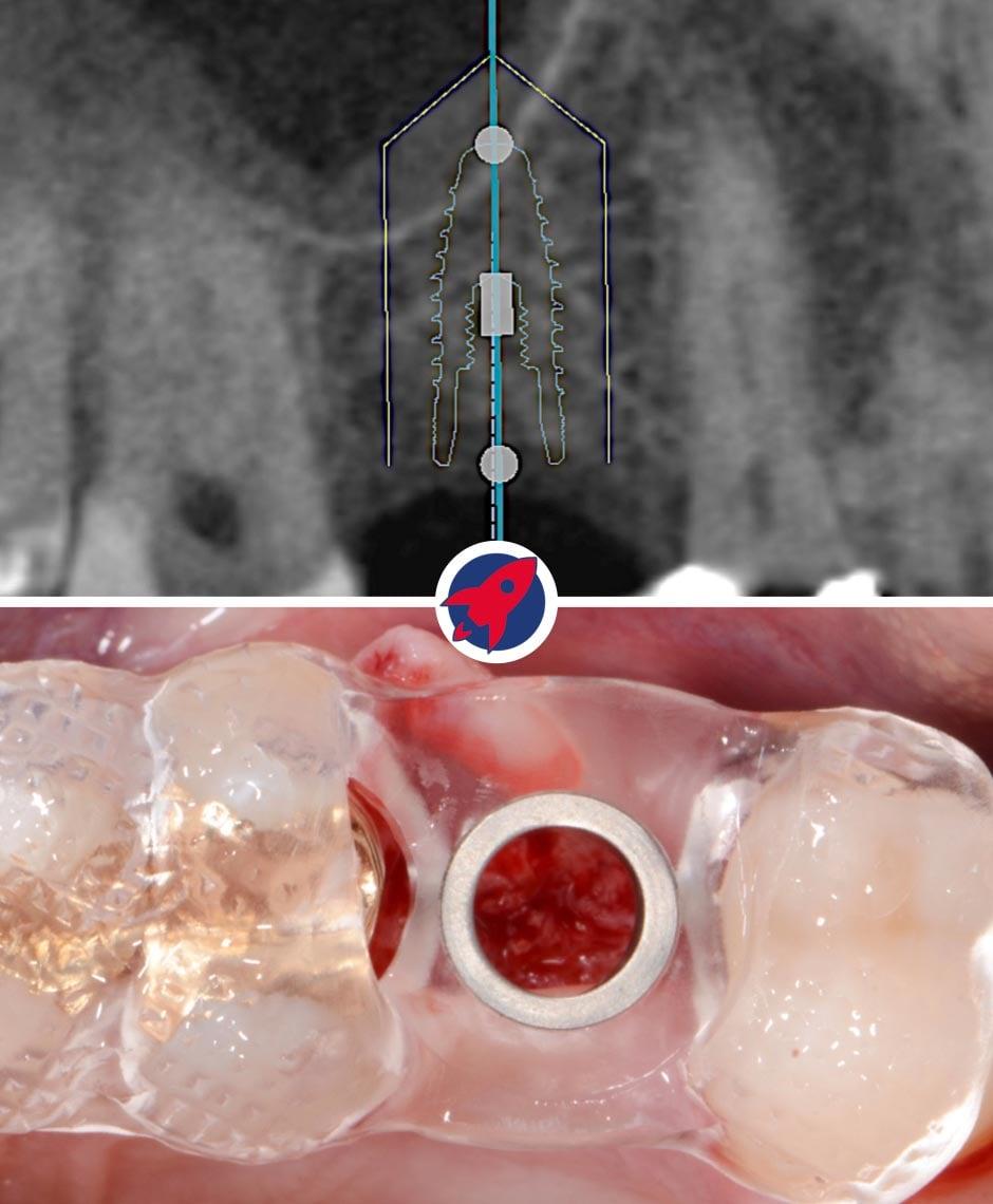 Planung eines Zahnimplantats mittels 3D-Bildgebung: Ein detailliertes 3D-Röntgenbild zeigt die exakte Positionierung eines Zahnimplantats im Kiefer. Die Grafik illustriert die präzise Implantatplanung mit sichtbaren Messlinien für eine passgenaue Einbringung zwischen den Zähnen.
