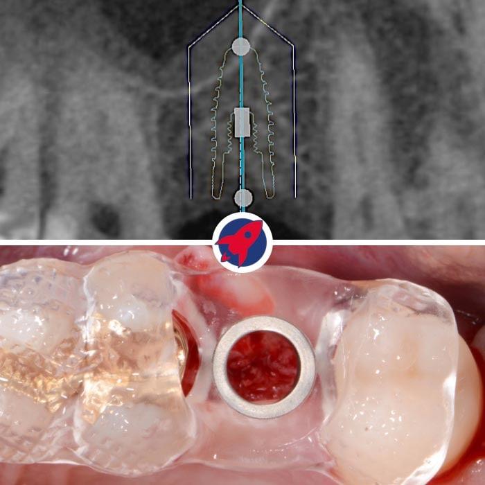 Planung eines Zahnimplantats mittels 3D-Bildgebung: Ein detailliertes 3D-Röntgenbild zeigt die exakte Positionierung eines Zahnimplantats im Kiefer. Die Grafik illustriert die präzise Implantatplanung mit sichtbaren Messlinien für eine passgenaue Einbringung zwischen den Zähnen.