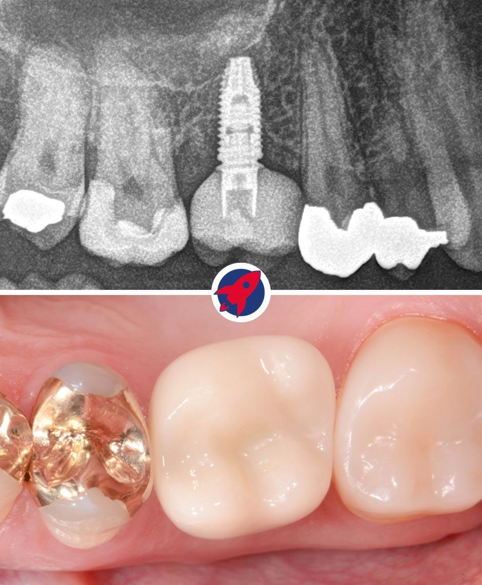 Endgültige Ansicht eines Zahnimplantats mit Krone: Hier ist das finale Ergebnis einer Implantatbehandlung zu sehen, bei dem das Implantat vollständig im Kiefer integriert ist und mit einer individuell angefertigten Zahnkrone abgeschlossen wird, die sich nahtlos in die natürliche Zahnreihe einfügt.