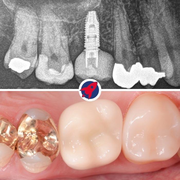 Endgültige Ansicht eines Zahnimplantats mit Krone: Hier ist das finale Ergebnis einer Implantatbehandlung zu sehen, bei dem das Implantat vollständig im Kiefer integriert ist und mit einer individuell angefertigten Zahnkrone abgeschlossen wird, die sich nahtlos in die natürliche Zahnreihe einfügt.
