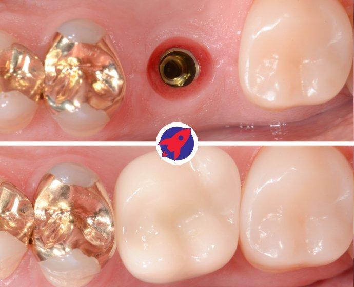 <p class="p1"><span class="s1">CBCT Planning and Guides</span></p>