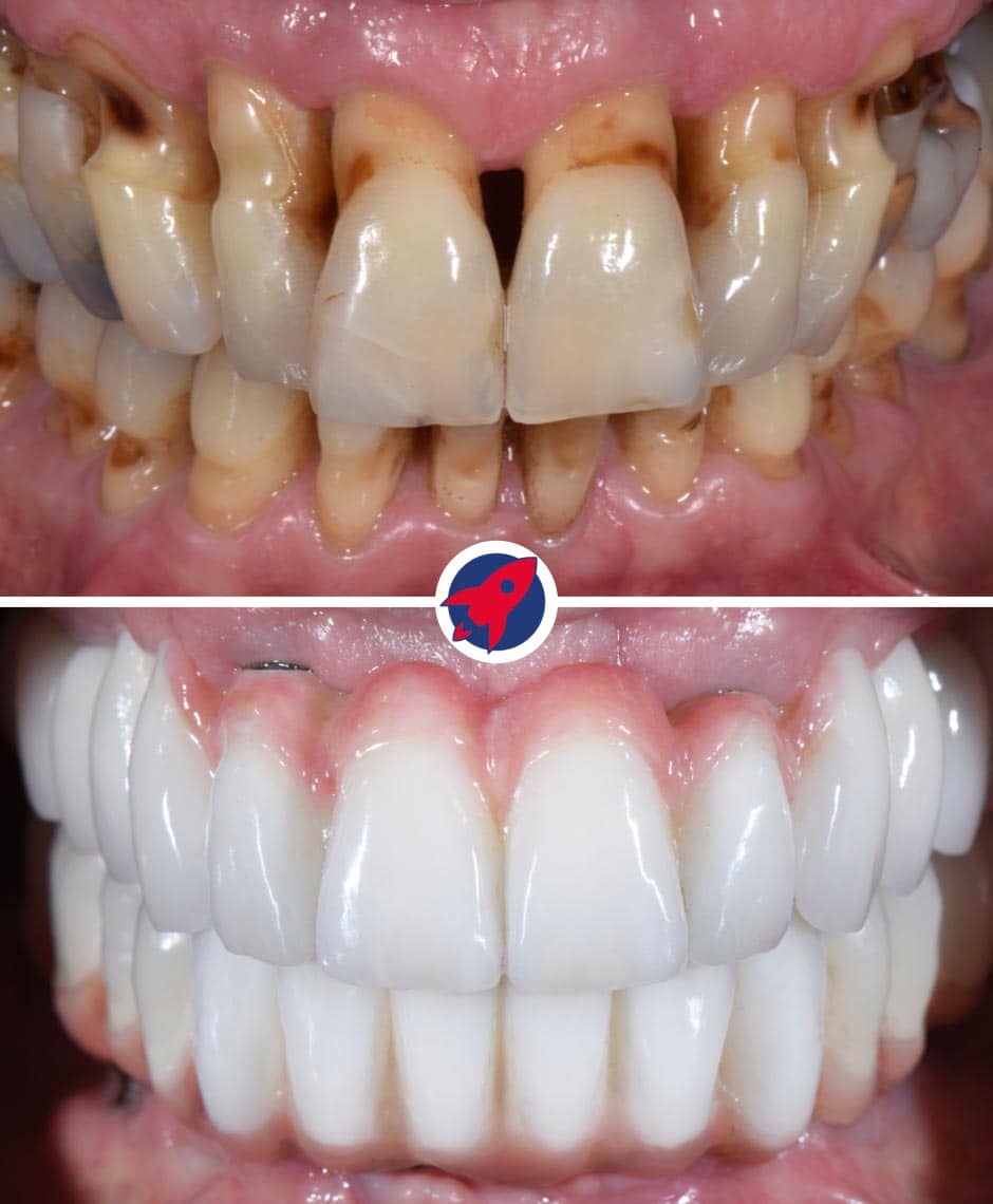 Vorher nachher Bilder eines Patientenfalls in dem die Zähne mittels einer festen Brücke auf 6 Implantaten ersetzt wurden.