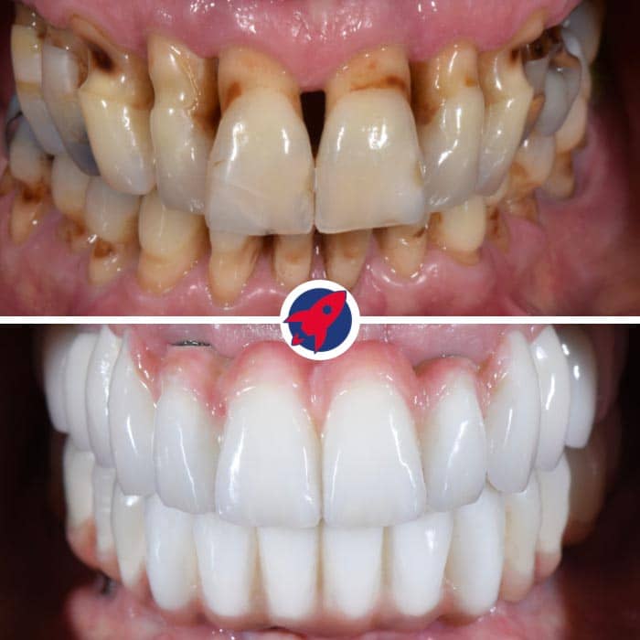 Vorher nachher Bilder eines Patientenfalls in dem die Zähne mittels einer festen Brücke auf 6 Implantaten ersetzt wurden.