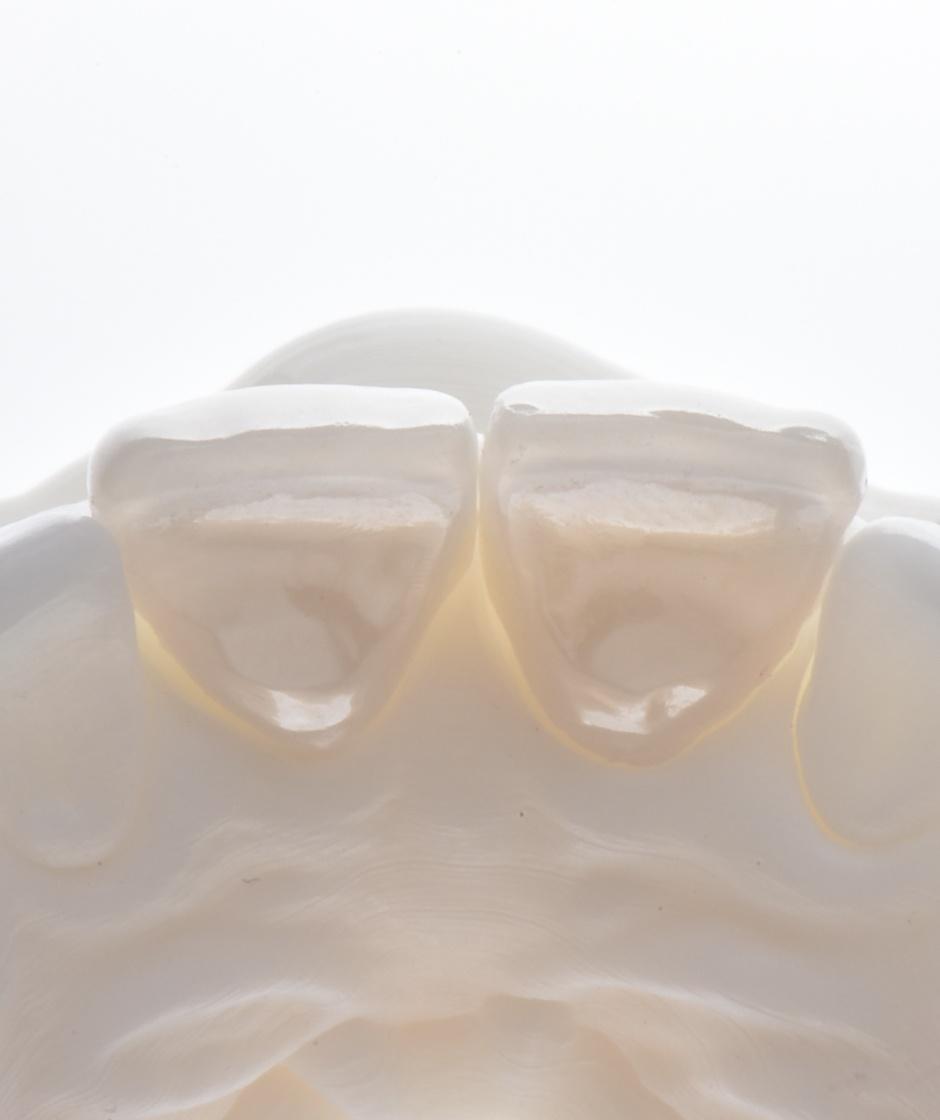 <p class="p1"><span class="s1">One-visit:<br />Scan • CAD • Mill • Sinter</span></p>