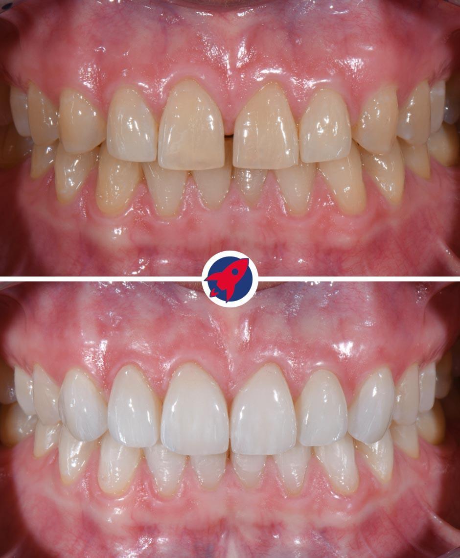 Vorher-Nachher-Bilder eines Patienten, der mit Invisalign und sechs Veneers behandelt wurde, um eine Zahnlücke (Diastema) zu schließen, demonstriert die transformative Kraft ästhetischer Zahnheilkunde.