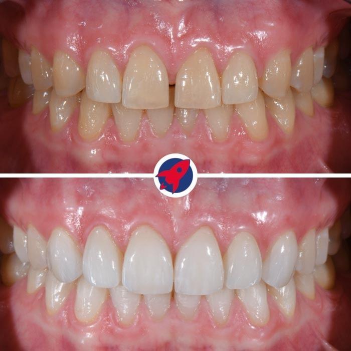 Vorher-Nachher-Bilder eines Patienten, der mit Invisalign und sechs Veneers behandelt wurde, um eine Zahnlücke (Diastema) zu schließen, demonstriert die transformative Kraft ästhetischer Zahnheilkunde.