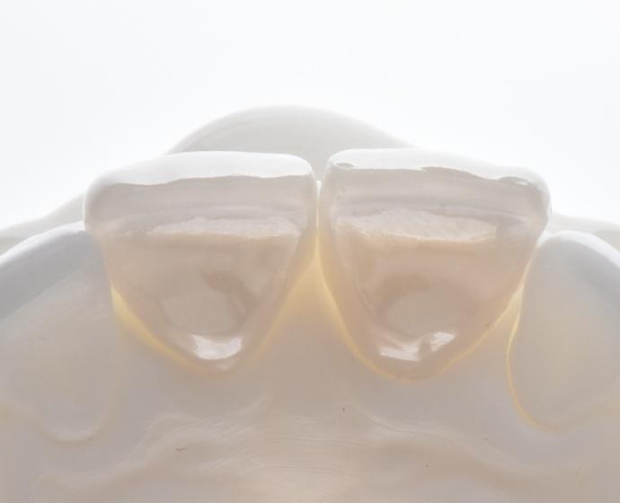 <p class="p1"><span class="s1">One-visit:<br />Scan • CAD • Mill • Sinter</span></p>