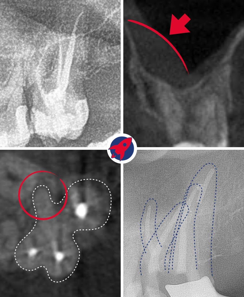 Erfolgreiche Revision einer Wurzelkanalbehandlung mit 3D-Diagnostik. Dr. Horvath