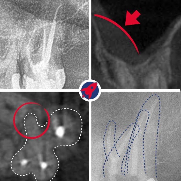 Erfolgreiche Revision einer Wurzelkanalbehandlung mit 3D-Diagnostik. Dr. Horvath