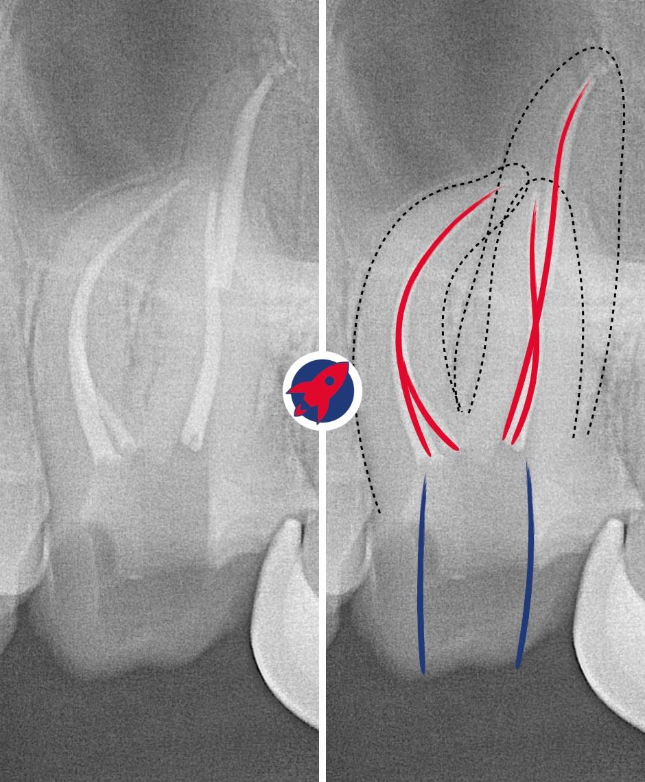 Röntgenbild einer idealen Wurzelkanalbehandlung an Zahn 26 in der Praxis Dr. Horvath in Jestetten nahe Zürich