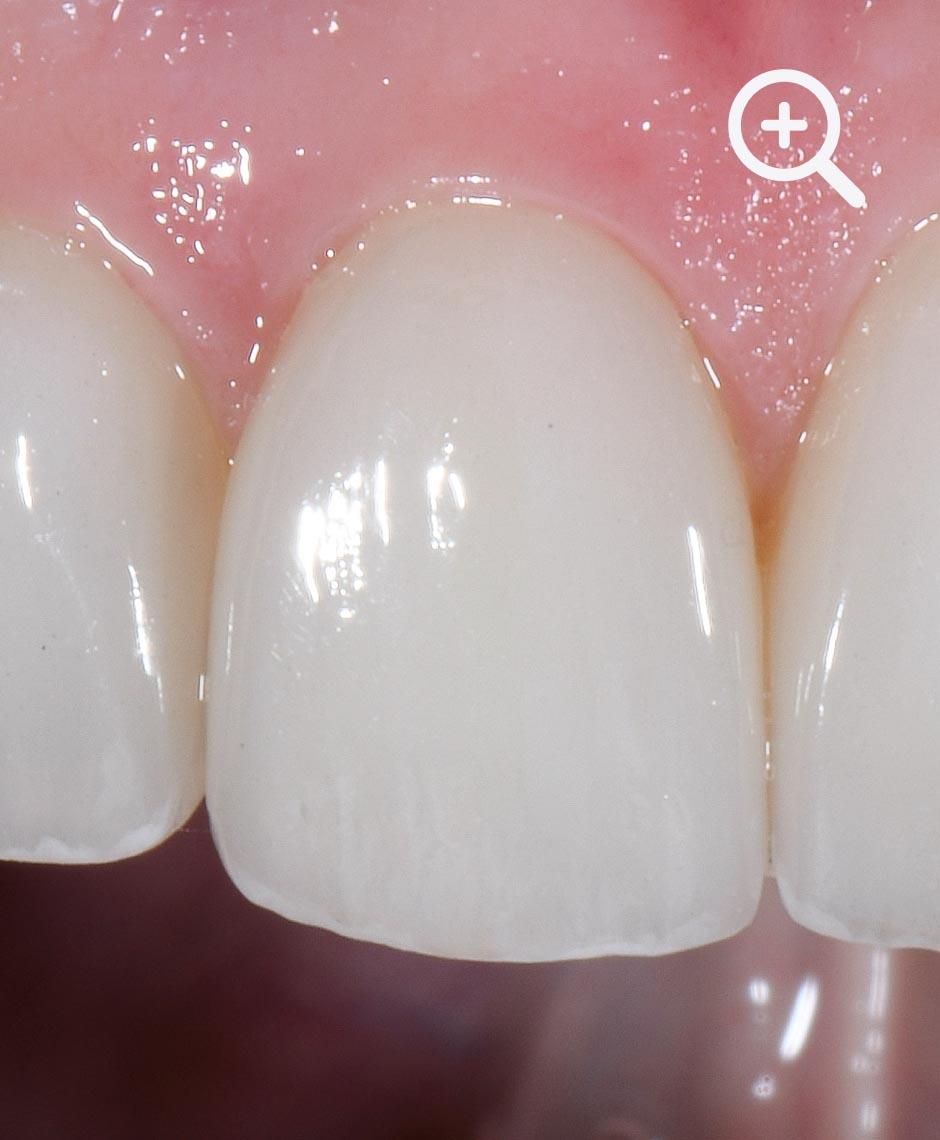 Detaillierte Vorher-Aufnahme der Zähne eines Patienten, die für eine ästhetische Behandlung mit individuellen Veneers vorgesehen sind, betont durch Dr. Horváth's Expertise in ästhetischer Zahnheilkunde.