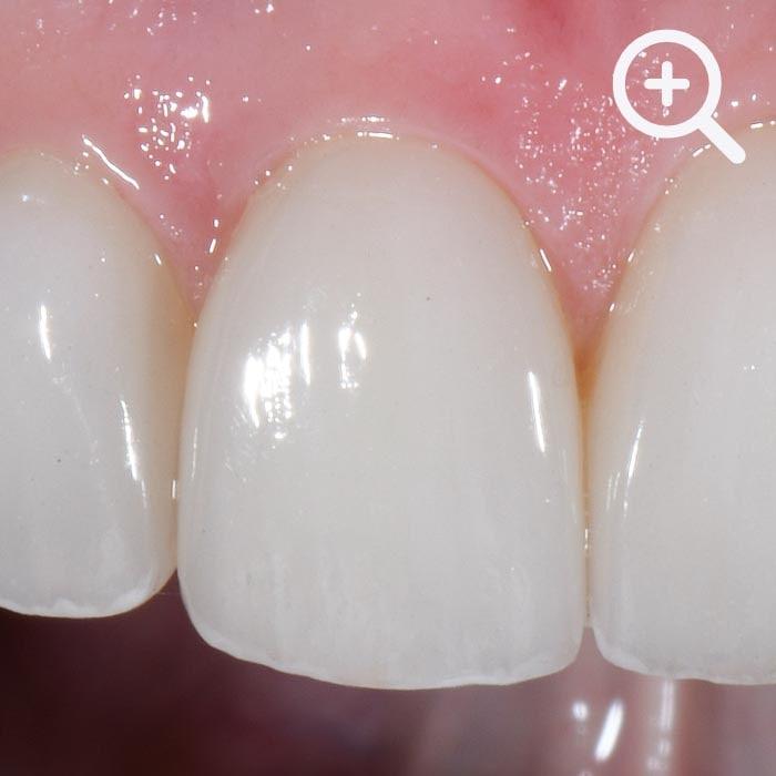 Detaillierte Vorher-Aufnahme der Zähne eines Patienten, die für eine ästhetische Behandlung mit individuellen Veneers vorgesehen sind, betont durch Dr. Horváth's Expertise in ästhetischer Zahnheilkunde.