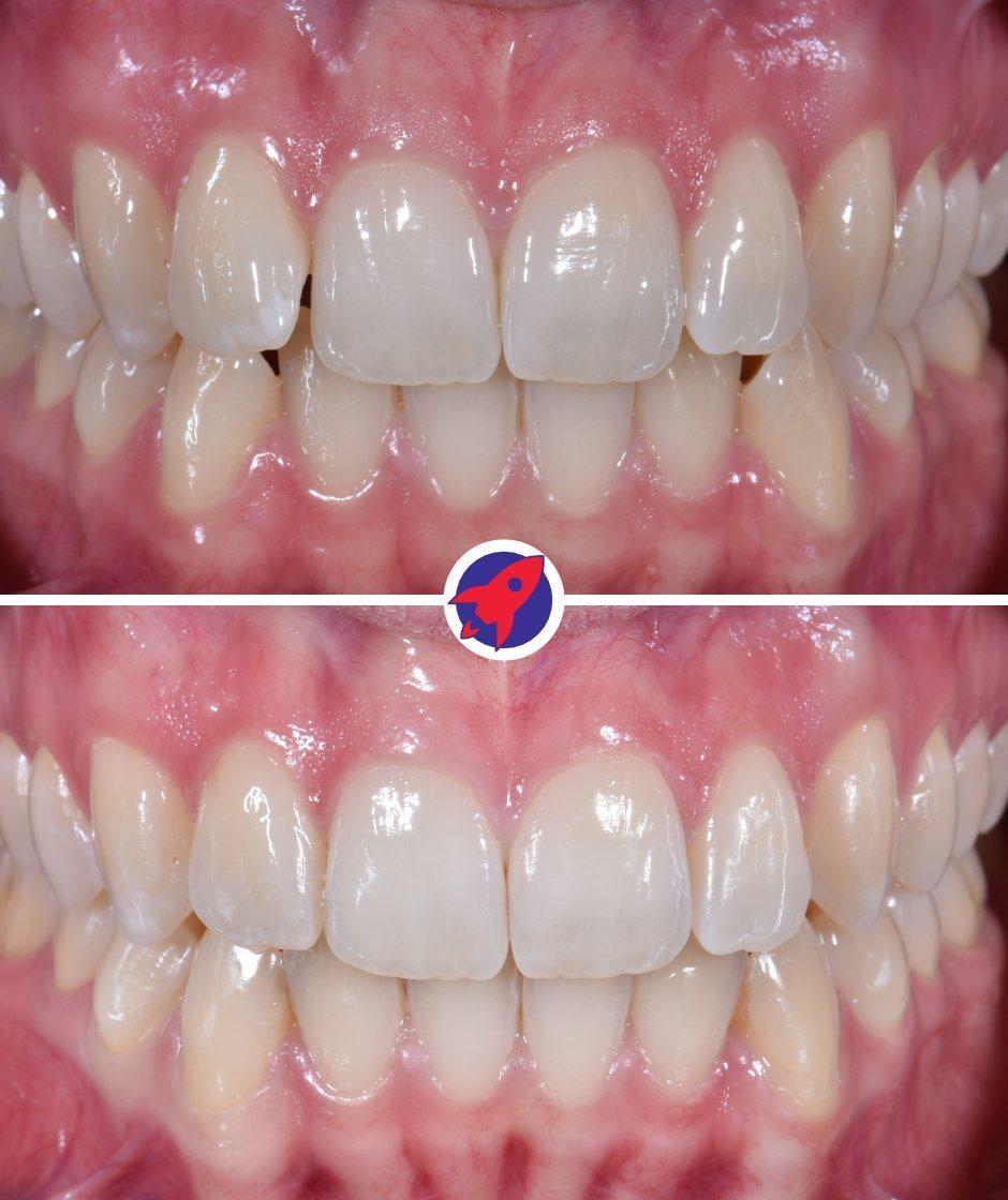 <p class="p1">Invisalign for uneven front teeth</p>
