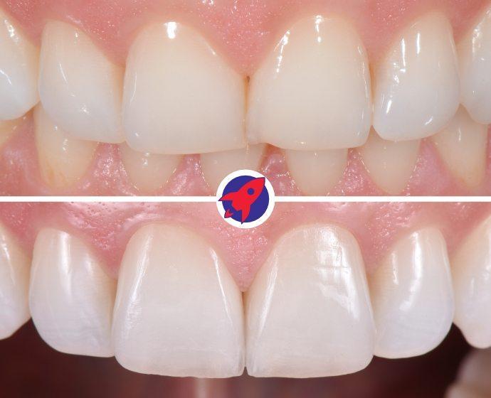 <p class="p1">Invisalign and veneers for a balanced smile</p>