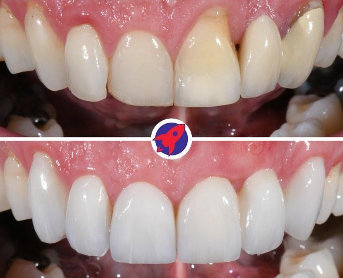 <p class="p1">Custom bridge for function and aesthetics</p>