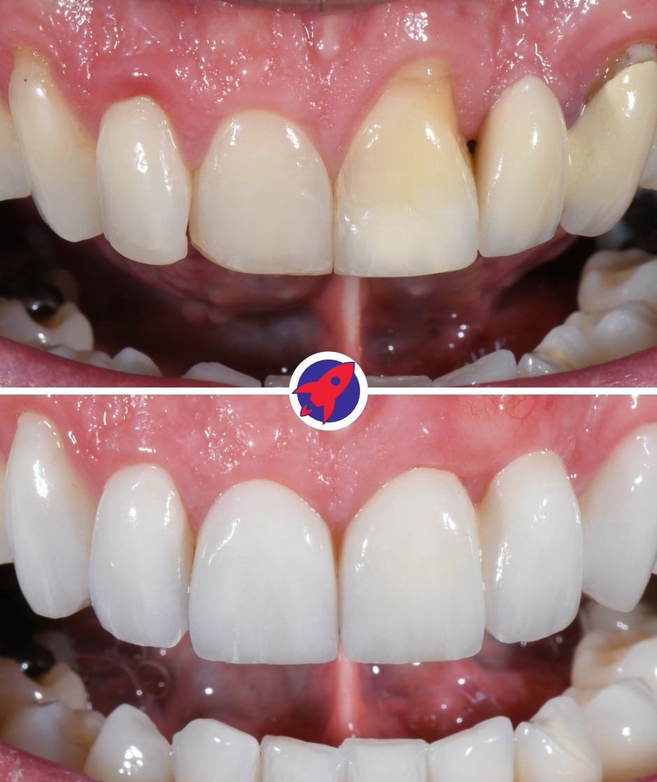 <p class="p1">Custom bridge for function and aesthetics</p>