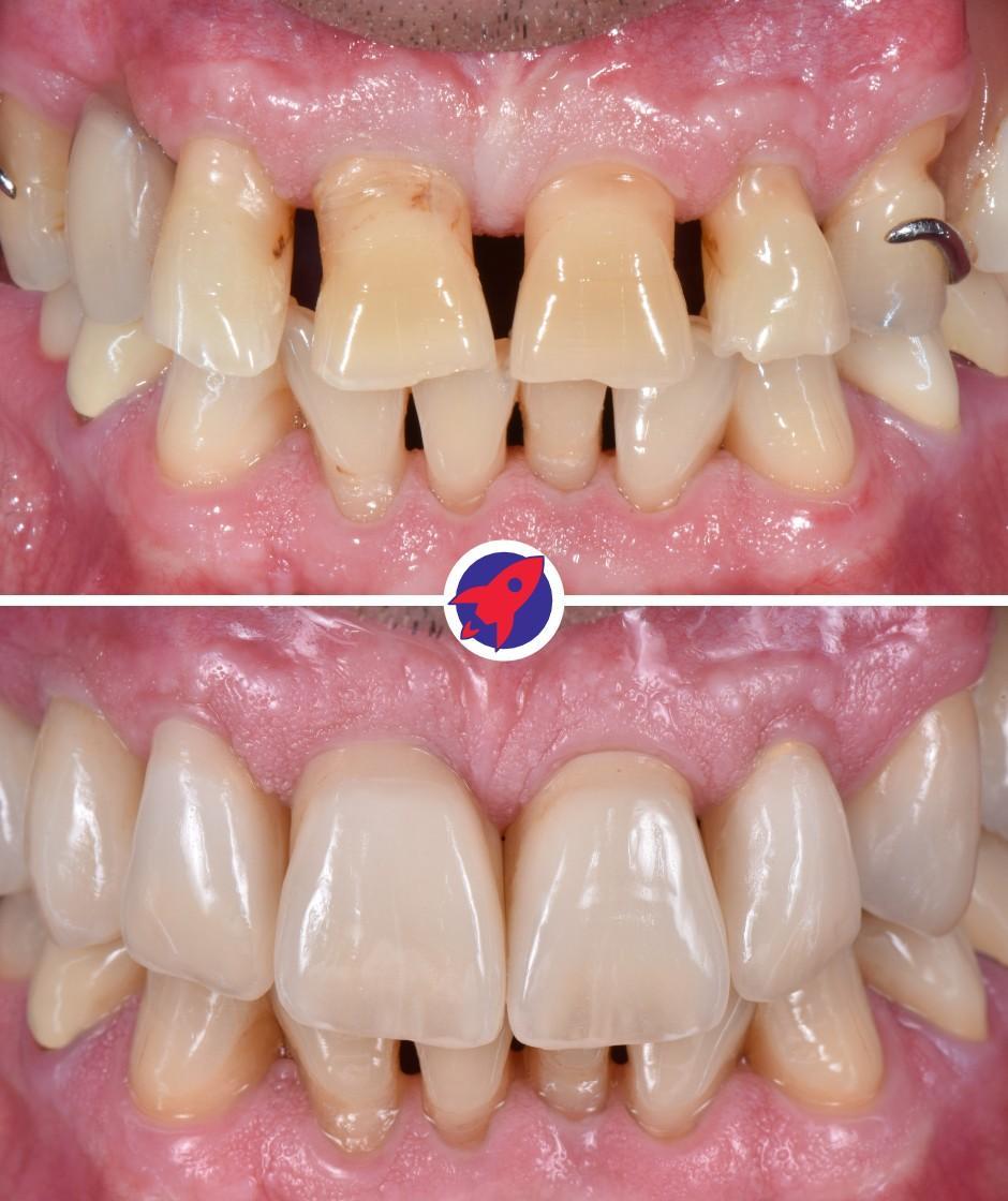 <p class="p1">Function and aesthetics permanently restored</p>