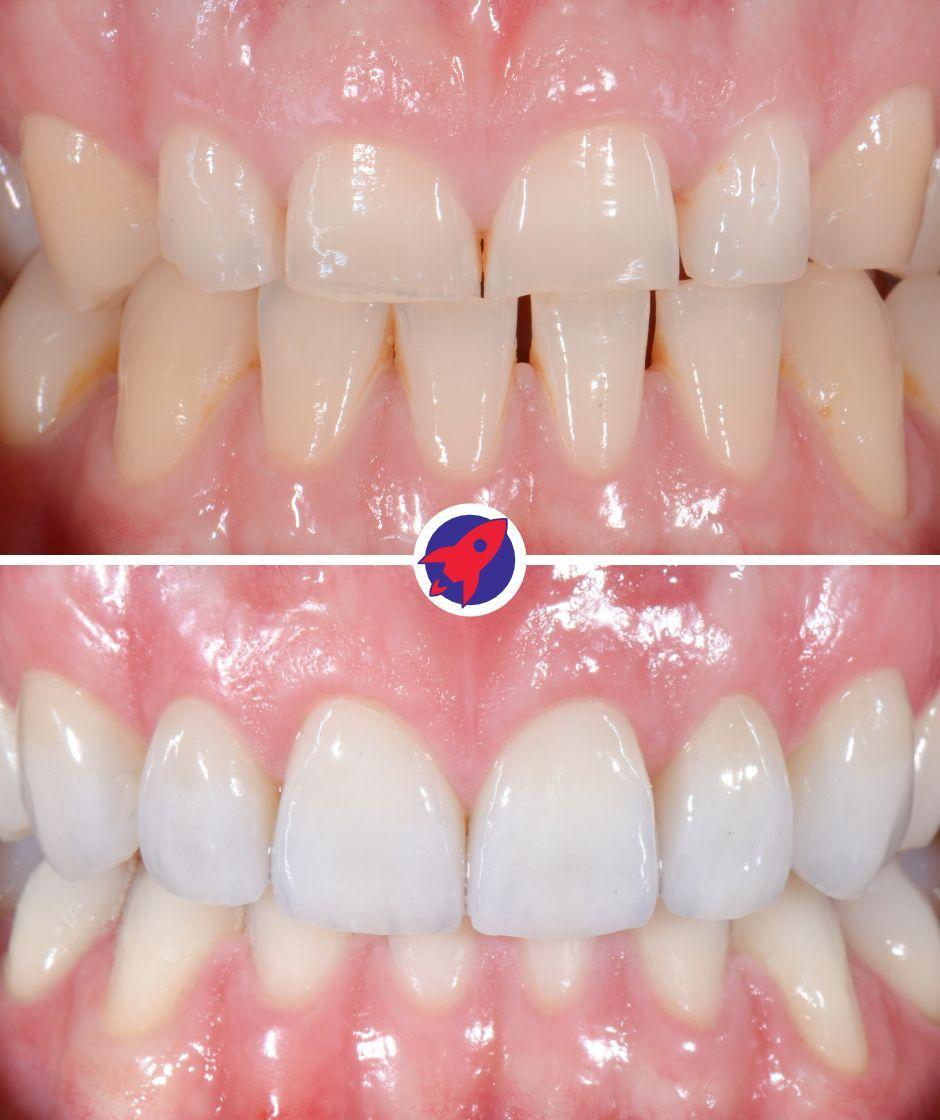 <p class="p1">Lingual braces and veneers for severe wear</p>