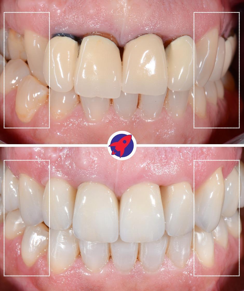 <p>Dental arch expansion for visible esthetics</p>