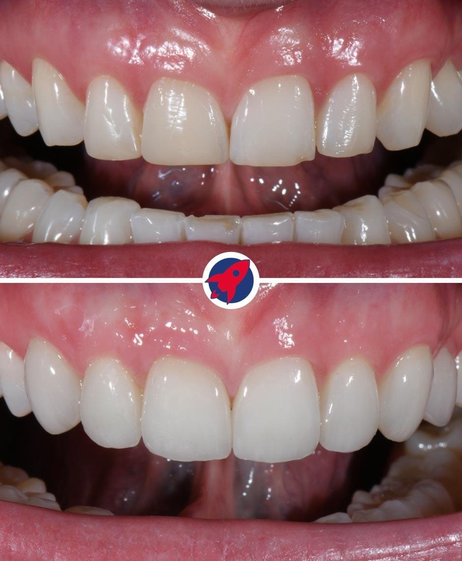 <p class="p1">Veneers for a softer, more harmonious smile</p>