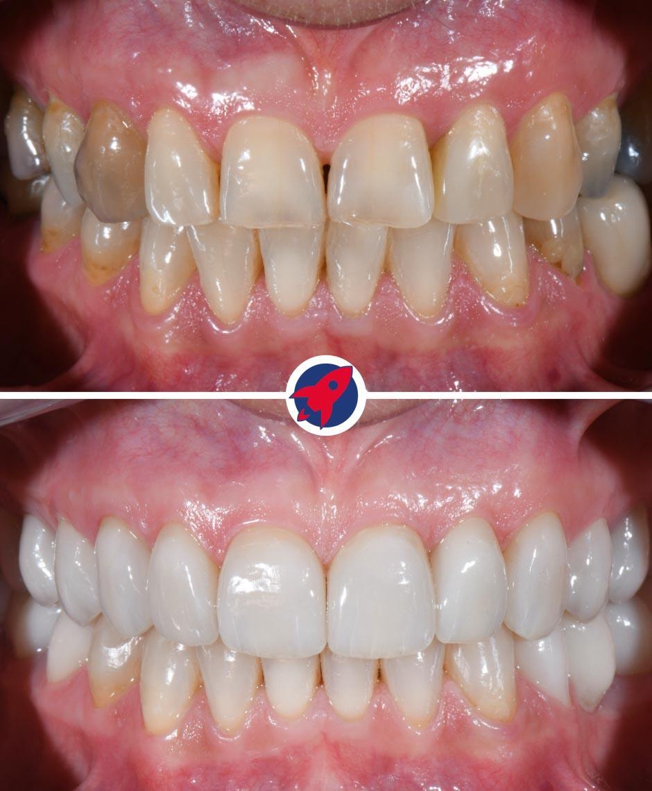 <p class="p1">Invisalign and veneers for function and aesthetics</p>
