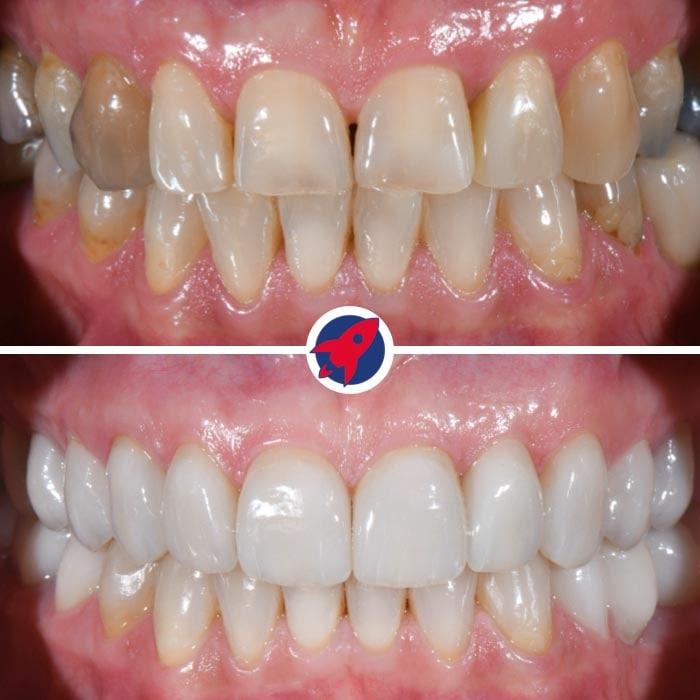 <p class="p1">Invisalign and veneers for function and aesthetics</p>