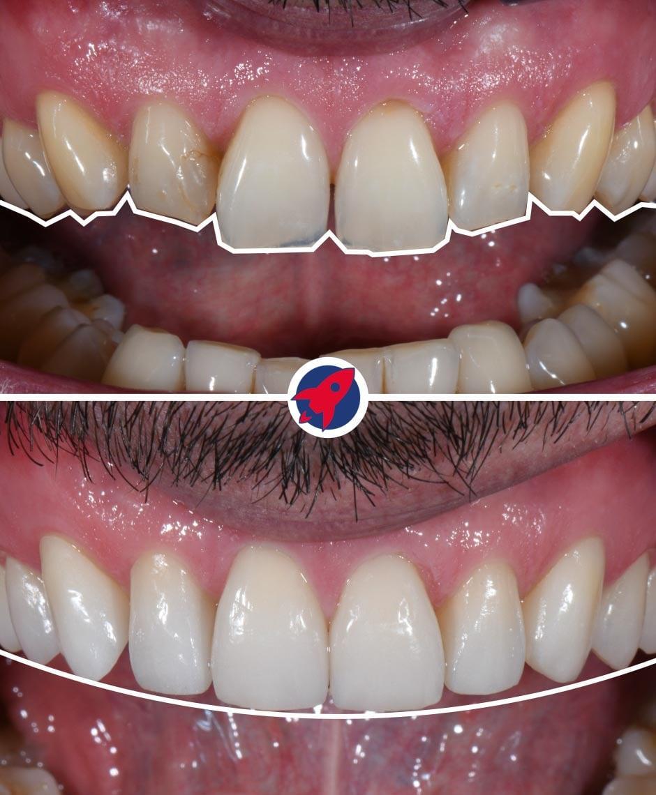 <p class="p1">Invisalign and 18 veneers for wear and misalignment</p>
