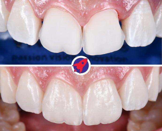 <p class="p1">Reconstruction after dental trauma</p>