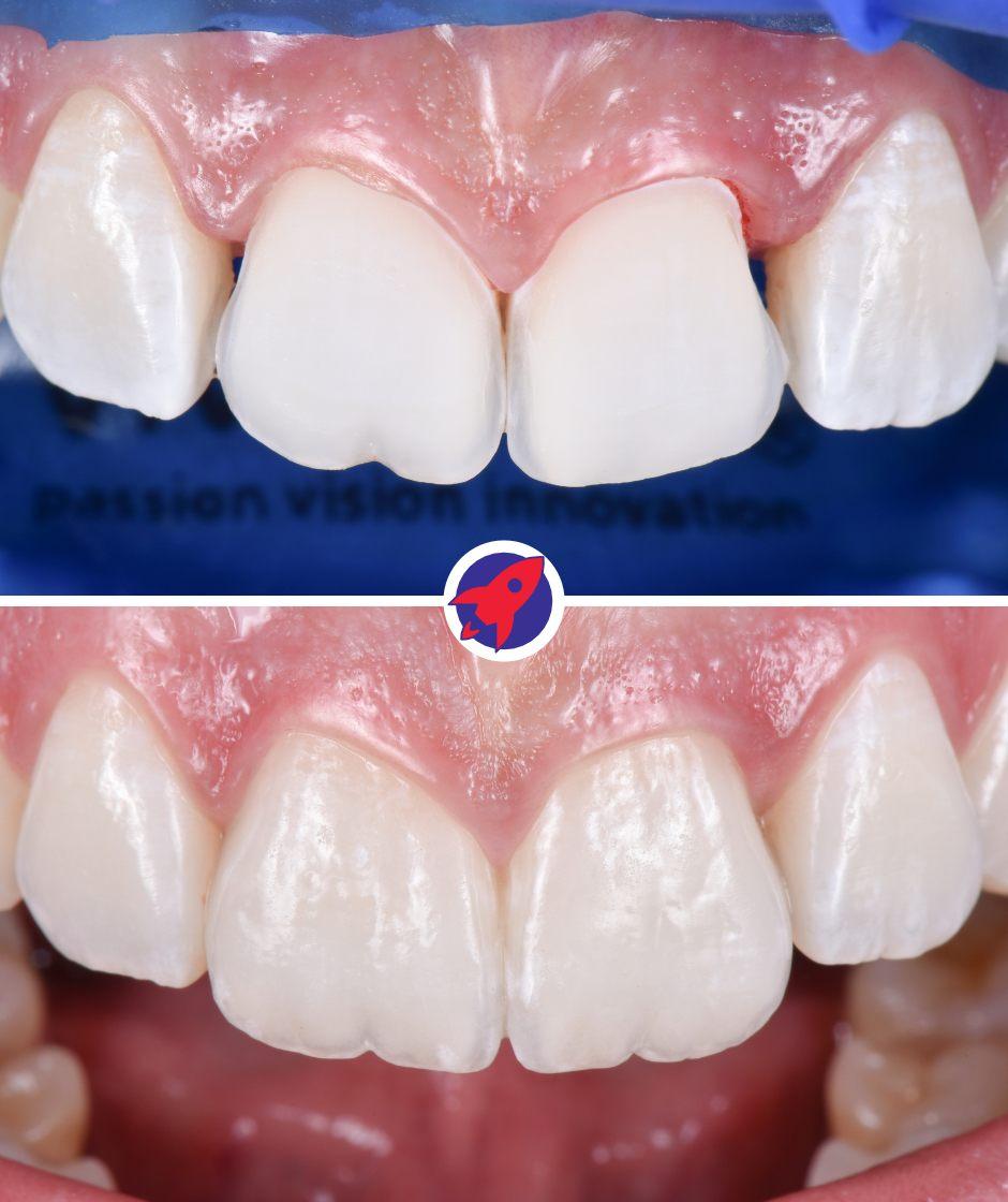 <p class="p1">Reconstruction after dental trauma</p>