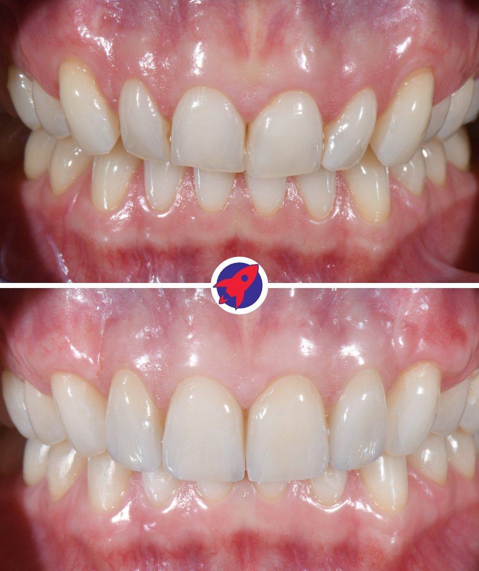 <p class="p1">Aligners, veneers and gum correction</p>